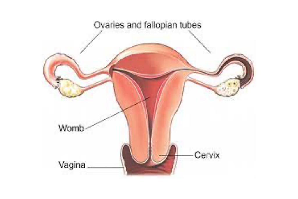 Hysterectomy